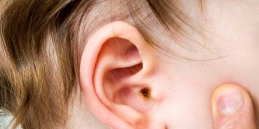 استشارى:
      الزكام
      سبب
      رئيسي
      في
      الإصابة
      بالتهابات
      الأذن
      الوسطى
      عند
      الأطفال