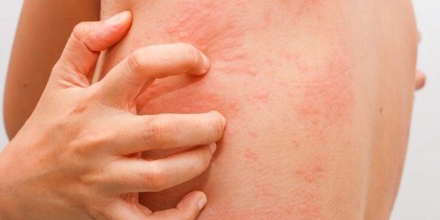 لنشر ٢.. الارتكاريا.. حساسية جلدية مفاجئة تصيب الملايين وطرق علاجها