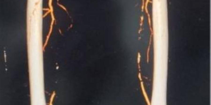 إنقاذ الطرف السفلي لمريض سبعيني بعد انسداد شرياني في مستشفى الملك خالد بحفر الباطن - المساء الاخباري