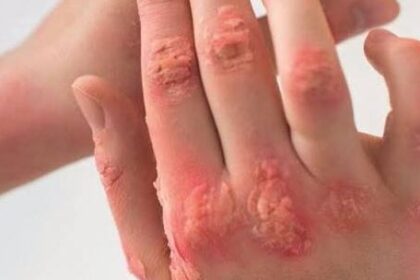اليونان تواجه أسوأ تفشٍ لفيروس غرب النيل في تاريخها